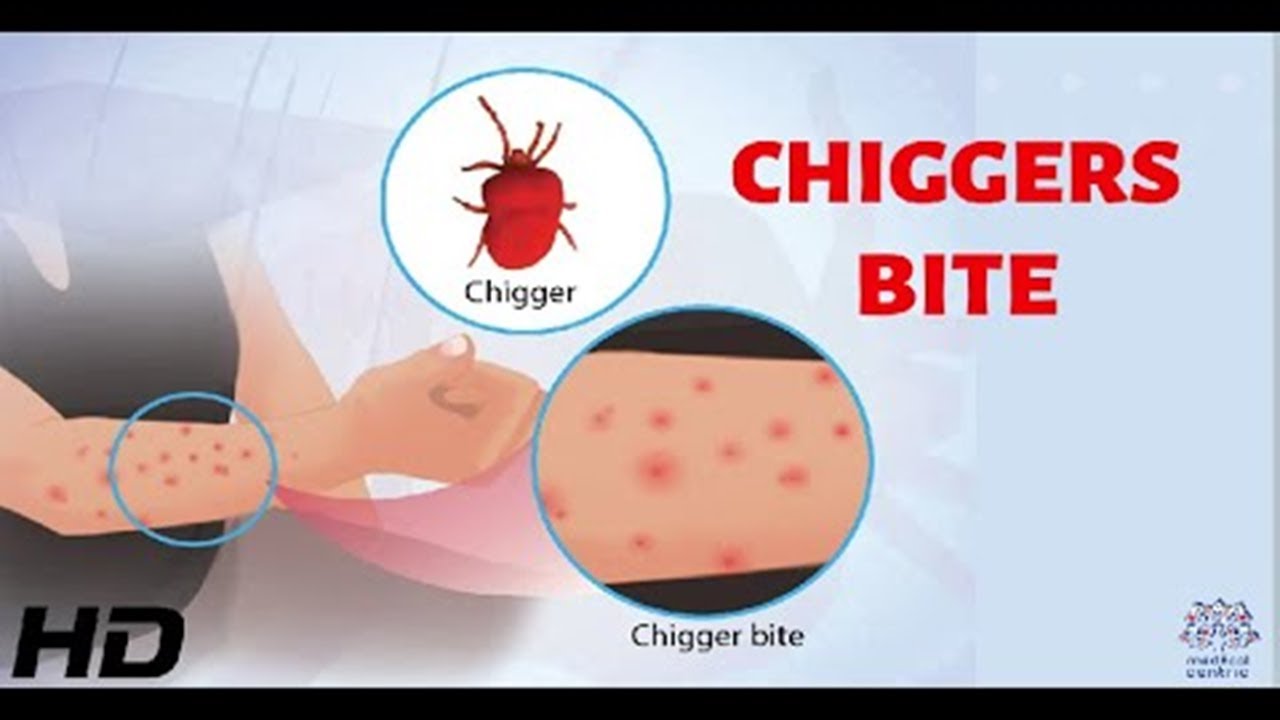 chigger bites vs bed bug bites