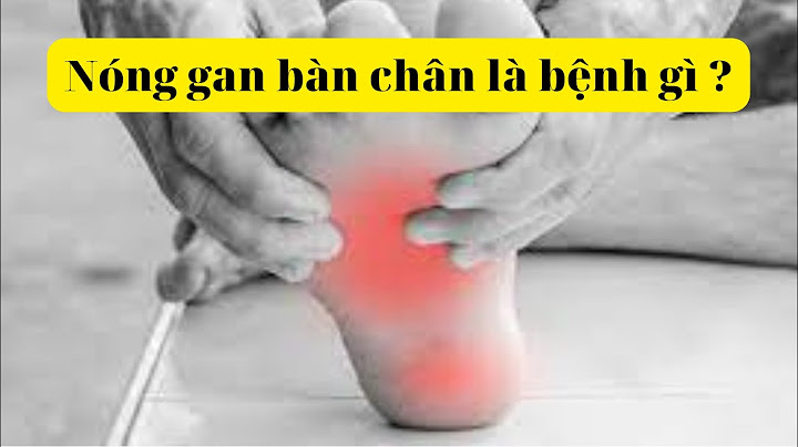 Bàn chân nóng là bệnh gì năm 2024