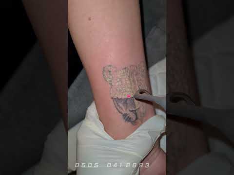 Pico lazerle dövme