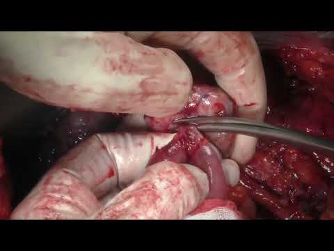 Ovarian Cancer Surgery performed by Pr. Kridelka