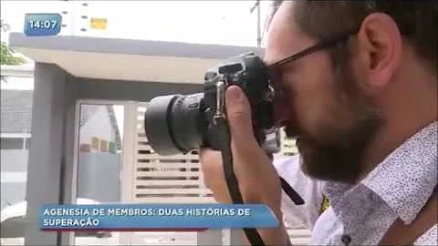 O que é agenesia de membros?