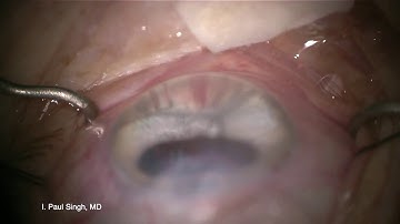 MIGS - Combining OMNI Viscodilation and Hydrus Microstent Implantation- Dr. Paul Singh, MD