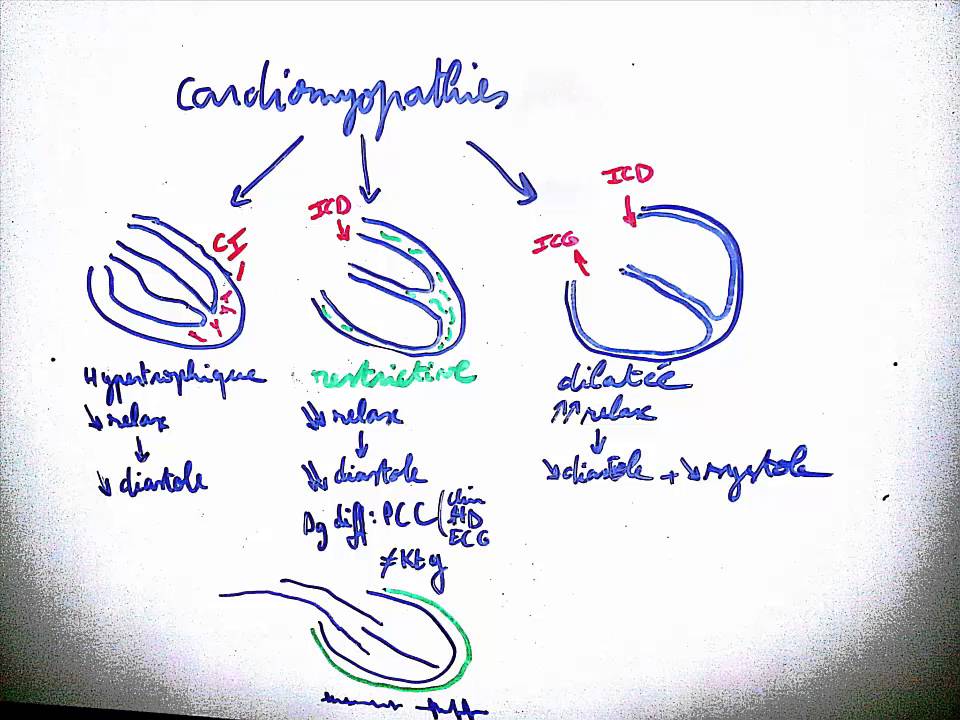 Smartn'Easy - Cardiomyopathies - Dr Astuce