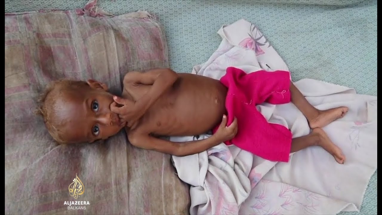 36 ألف طفل يموتون جوعاً في اليمن
