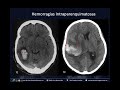 HEMORRAGIAS INTRACRANEALES