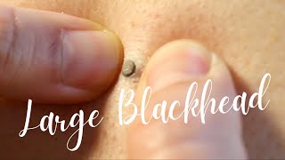 HOW TO REMOVE A LARGE OPEN COMEDOME (BLACKHEAD) WITHOUT TOOLS