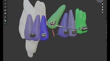 Treat an impacted canine with minimum side effect on adjacent teeth using simulation software .