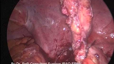 Laparoscopic Appendectomy (Perforated Appendix) By Dr. Rafil