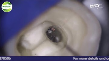 BROKEN TOOL REMOVER PEN BY CERKAMED | Biodent Care Services