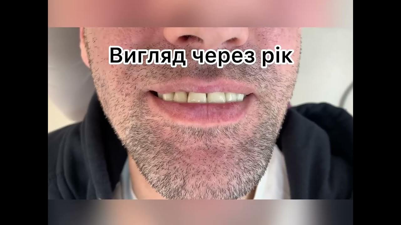 композитні вініри та керамічні вініри. Що краще вибрати - YouTube
