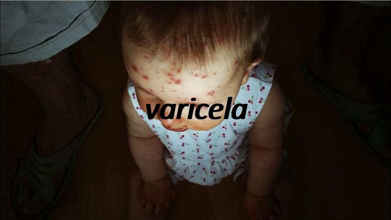 How to say chickenpox in Spanish? varicela YouTube