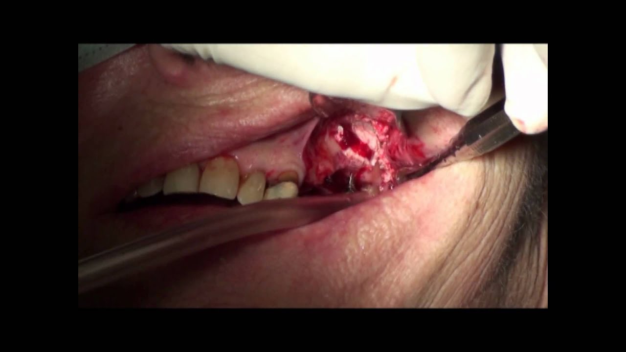 Bondbone , sinus lift and vertical augmentation mpg implants straumann