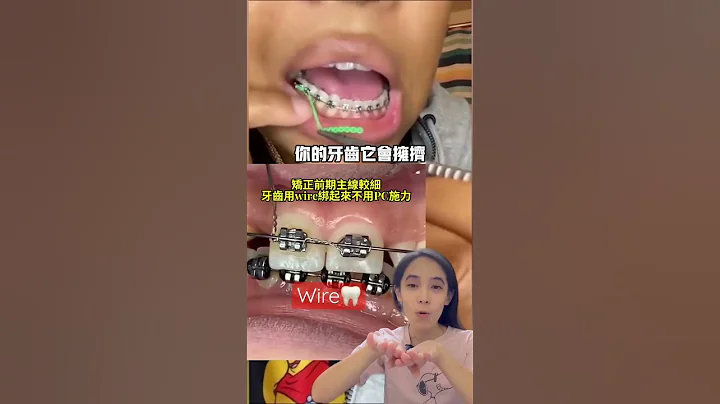 自己DIY綁牙套橡皮筋可以嗎#牙齒矯正 - 天天要聞