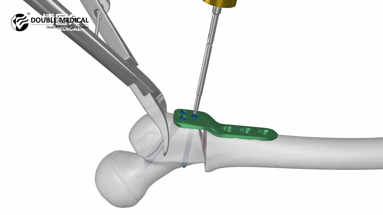 hip osteosclerosis 2 fokozatú kezelés