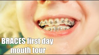 Braces First Day Mouth Tour Close Up