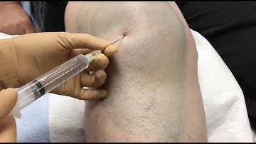 Arthrocentesis CPT code - simplify medical coding