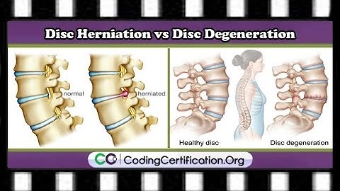 HCPCS and CPT Codes FAQs | Disc Herniation vs. Disc Degeneration