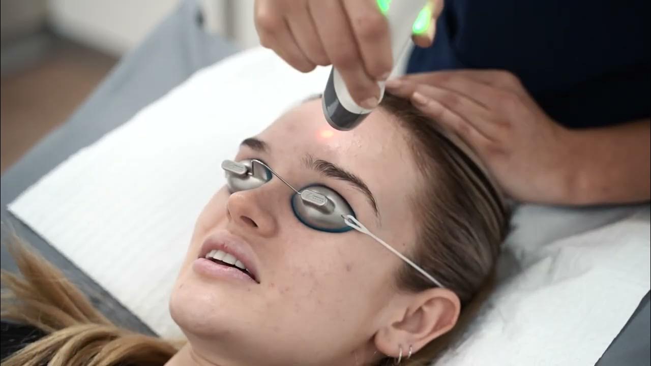 Laser Genesis for Acne, Rosacea & Rejuvenation (Cutera) YouTube