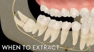 Dr. O'Neill Discusses the Best Time to Remove Your Wisdom Teeth