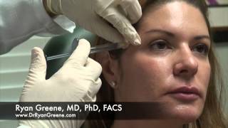 Juvederm Voluma Treatment of Temples in Fort Lauderdale