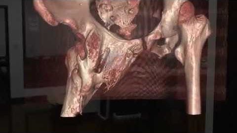 Vizua + Hololens viewing Nanjing Gu Lou Hospital 3D hip CT data