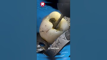 AMAZING Silver Filling Removal ASMR 4k #shorts #asmr