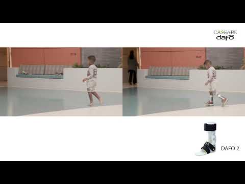 Before and After: Excess Plantarflexion - Toe Walking | DAFO 2