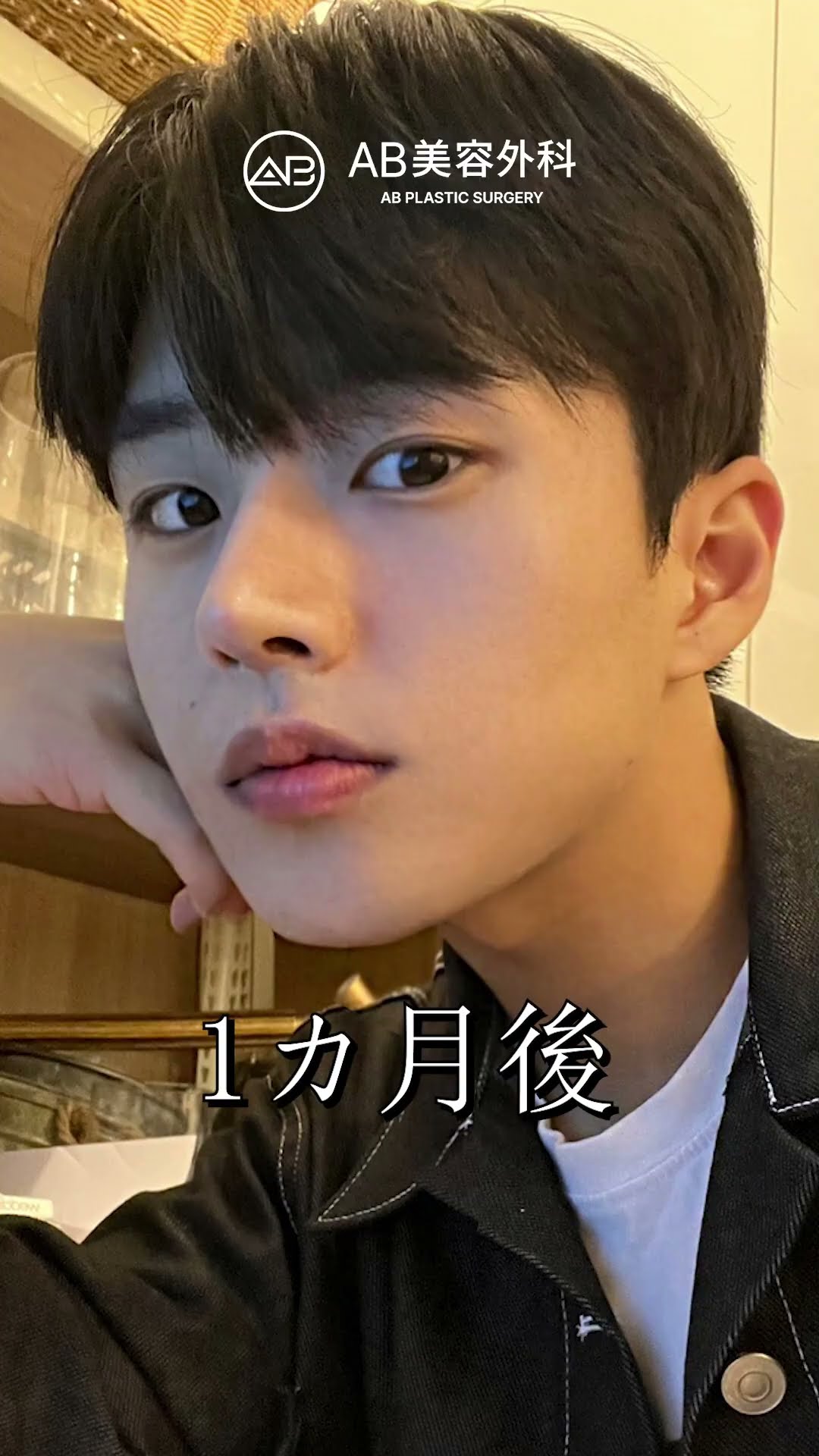整形でこんなに変わるの？男の劇的ビフォーアフター！ #shorts
