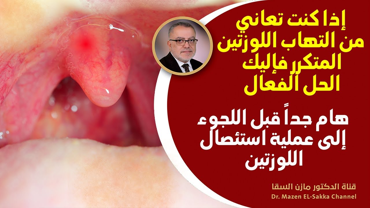 كيف تتخلص من التهاب اللوزتين والحلق بأسرع وقت وهل الحل عملية استئصال اللوز لماذا يحدث الالتهاب أصلا