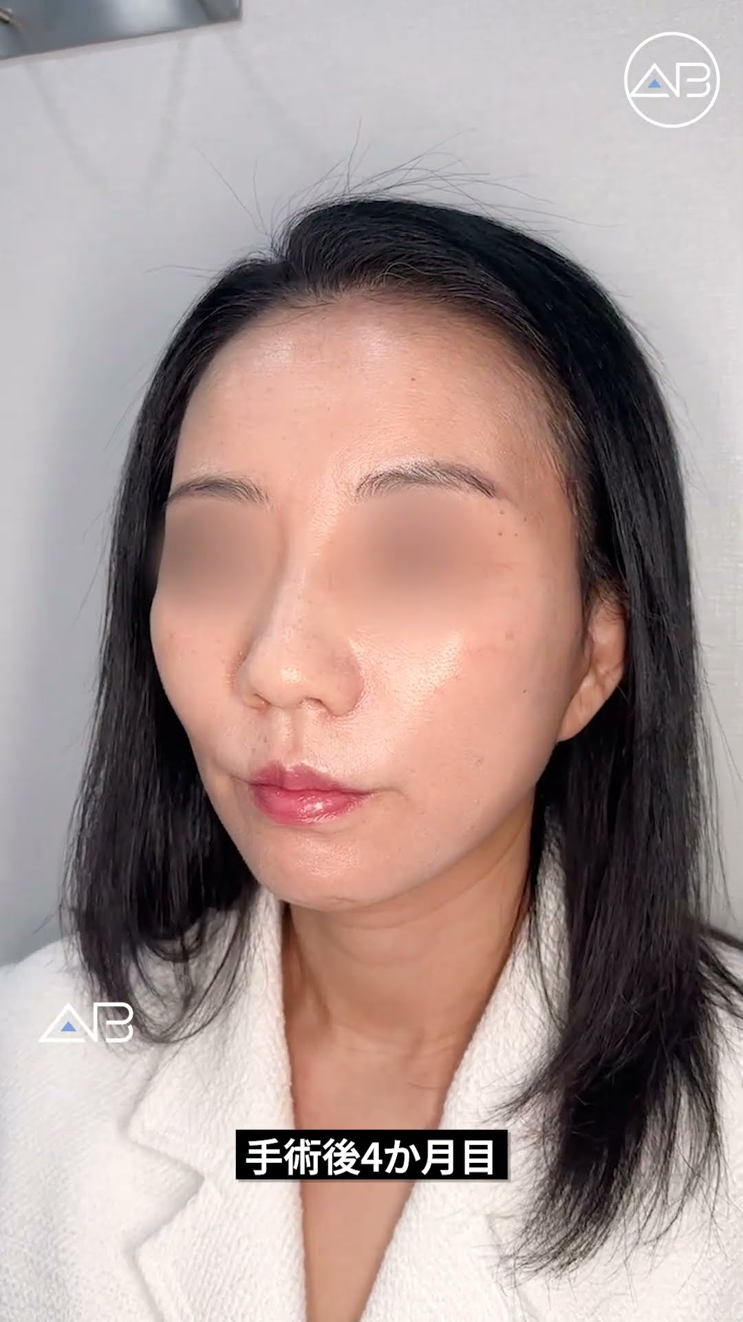 驚くべき肌の変化！リフトアップで実現する若返り | AB整形外科 #韓国整形 #美容