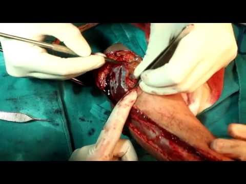 Female to Male Sex Change Surgery in India (Phalloplasty)