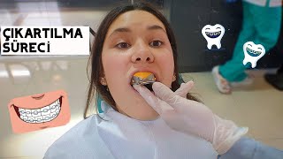 Di̇ş Telleri̇m Çikiyor -Yapılan İşlemler, Kullanacağım Malzemeler-