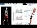 A computerbased model of above knee amputees to evaluate gait mechanics