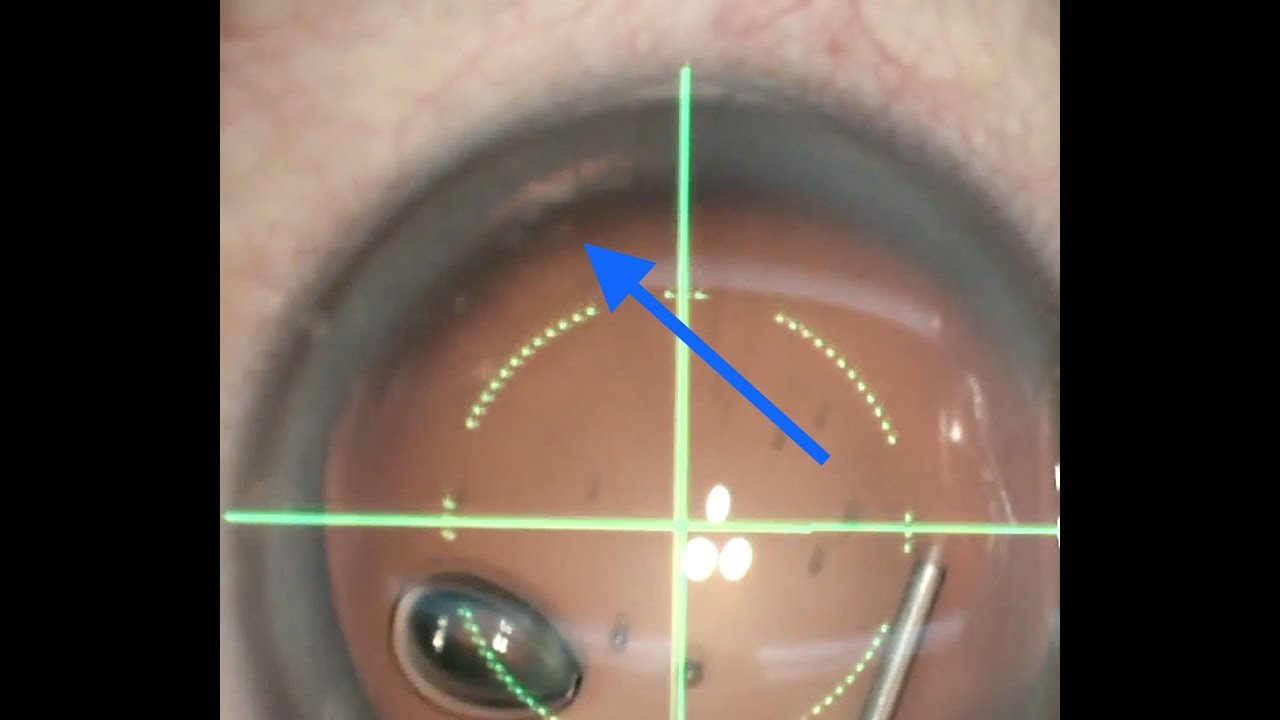 Complicated cataract surgery Zonular dehiscence, dialysis with toric