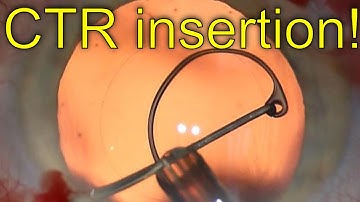 Capsular tension ring - atraumatic insertion technique with Sinskey hook - Dr Simon Chen 1080p HD