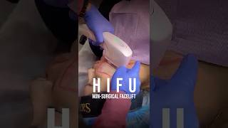 Face Slimming Without Surgery Hifu Treatment By Dr Adarsh Tripathi - Sarayu Clinics