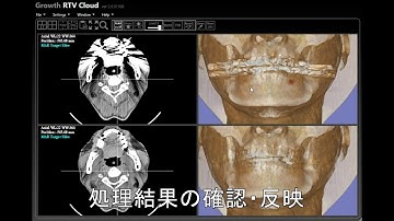 AI-Based Metal Artifact Reduction Cloud Service
