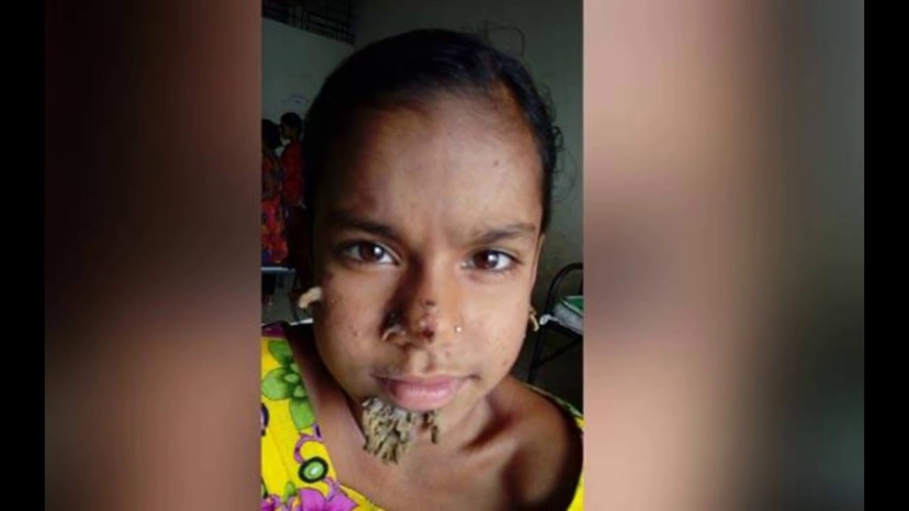 TREE MAN SYNDROME GIRL BANGLADESH FIRST FEMALE PATIENT YouTube
