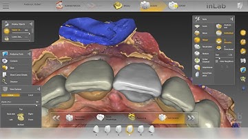 How I design a 6 unit anterior case
