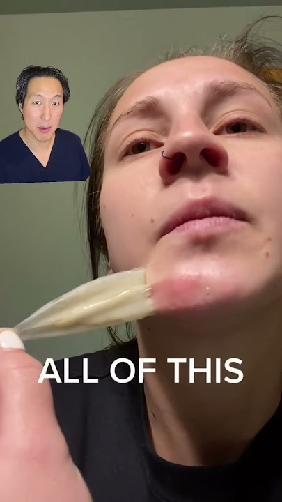 What Does a Hydrocolloid Patch Do For Acne? #acne #hydrocolloid