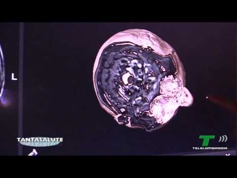 Dott. Francesco Dimeco Direttore Dip. Neurochirurgia