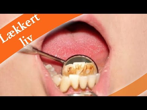 Video: Årsager til sort plak på et barns tænder: behandling