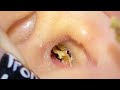ASMR耳掃除VS巨大耳垢！勝つのはどっち！？