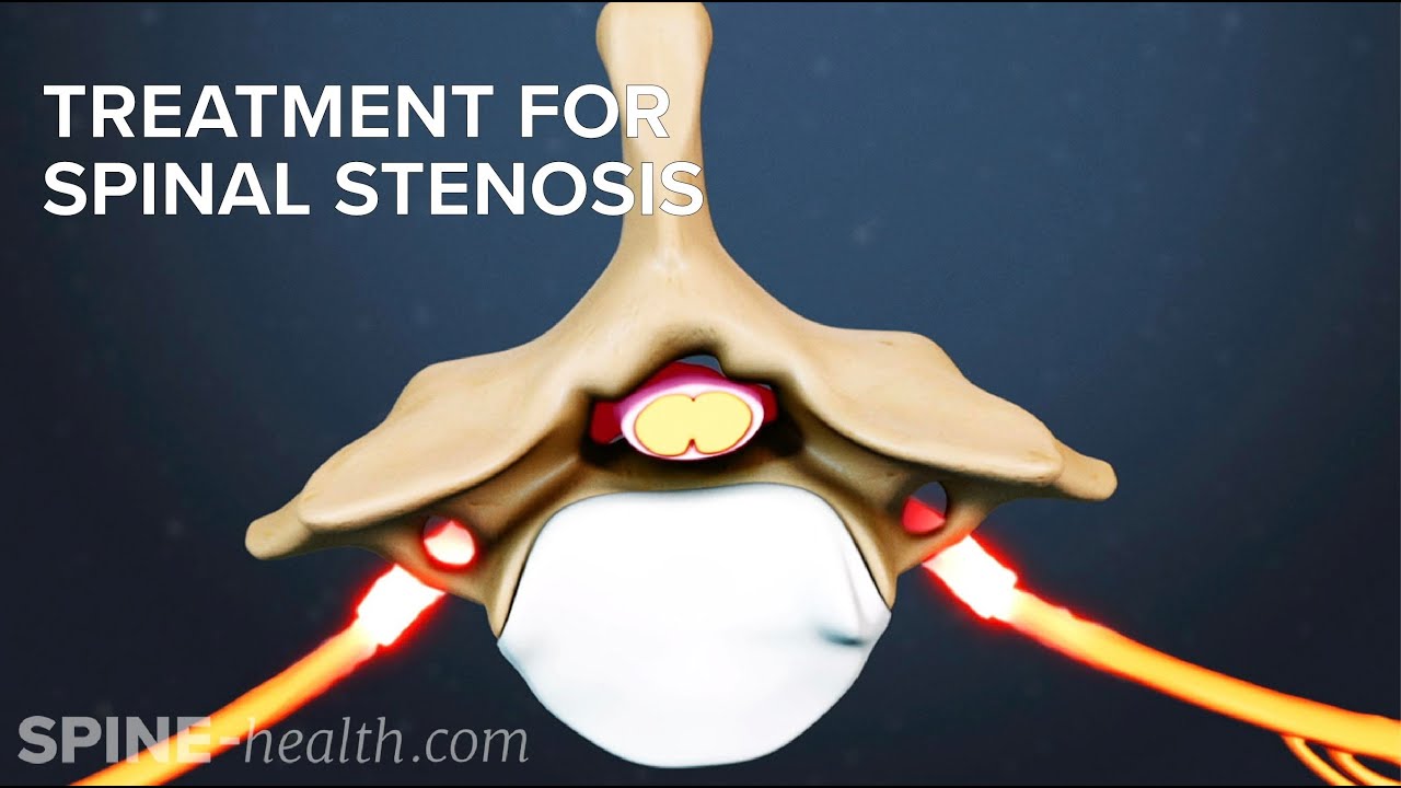 Treatment for Spinal Stenosis - YouTube