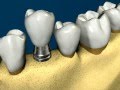 Ortodontia Associada a Implantodontia