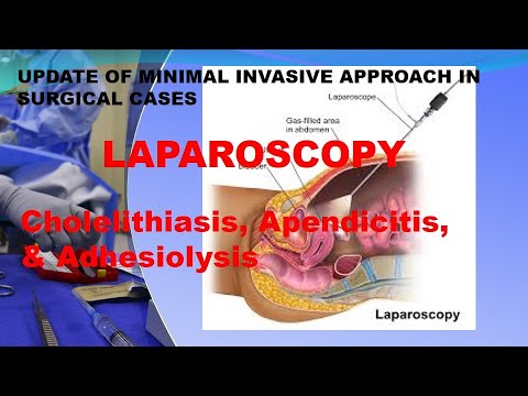 Minimal Invasive Surgery, LAPAROSCOPY