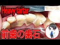 上尾の歯医者の歯周病治療・口臭の原因の歯石取り。鬼滅の刃パロ 歯滅の刃EP6 |,Mass tartar,टैटार, 韃靼,หินปูน,ขูดหินปูน口元美容・健康