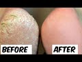 "Phati Aur Kadak Ediyon Ka Ilaj | Ghar Par Asaan Foot Remedy | Shazia beauty tips 