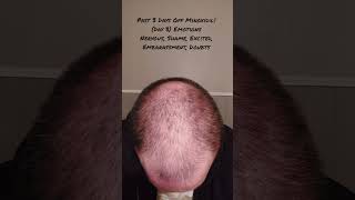 35 Year Old Emotions Day 3 Off Minoxidil 😬 With Aggressive Male Pattern Baldness #Shorts