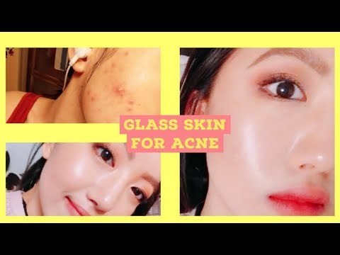 Glass Skin For ACNE PRONE SKIN, we can do it too! | Makeup/Skincare Tutorial